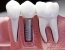 Implant - Missing teeth can be replace by an implant,