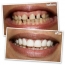 Labial Veneers - Smiles can be improve